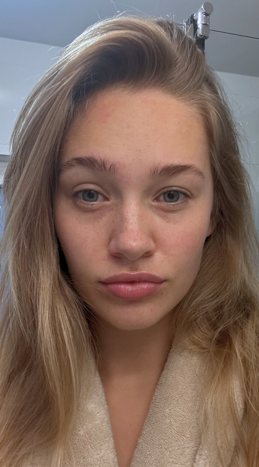 Foto voor behandeling — Bente W.