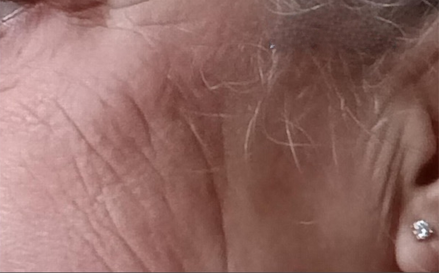 Foto voor behandeling — TINEKE H.