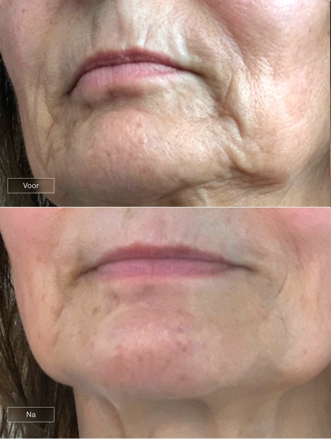Voor en na, mondzone